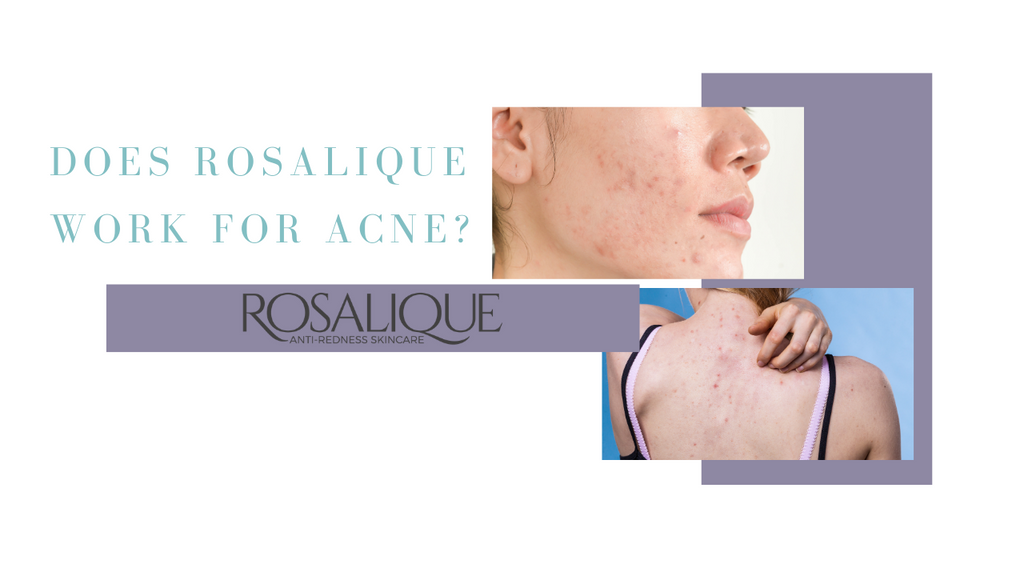 Does Rosalique work for Acne?