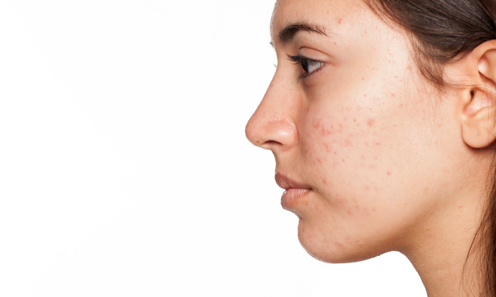 Acne Awareness, What Is Acne?